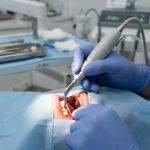 Inserto Helse Osteotomia Encaixe N