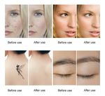 Removedor De Tatuagem A Laser