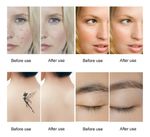 Removedor De Tatuagem A Laser