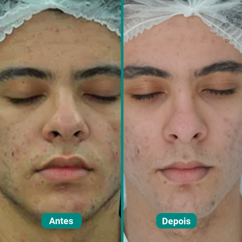 Kit Acne - Pro